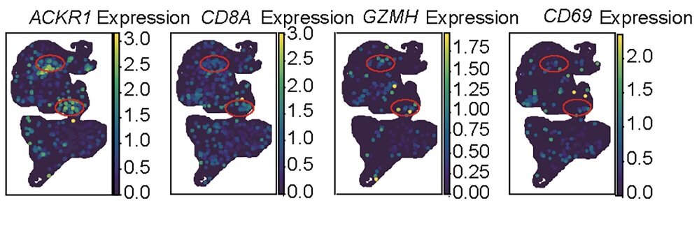 Figure 3. Spatial transcriptomics shows ACKR1⁺ endothelial cells adjacent to IFNG⁺:GZMH⁺ CD8⁺ T cells in TNT-treated tumors, suggesting immune–vascular niche formation. Source: Gao et al., Cancer Cell (2025).